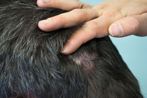 Eine hand streicht Haare zur Seite um die Kopfhaut zu untersuchen